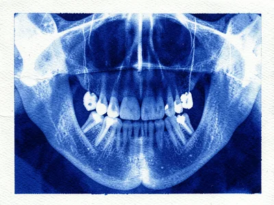 Dental x-ray panoramic aesthetic, full jaw with tooth roots visible in blue