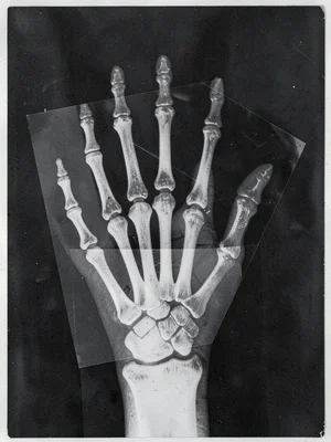 A photogram of a skeleton hand — bones as white silhouette on dark paper ground